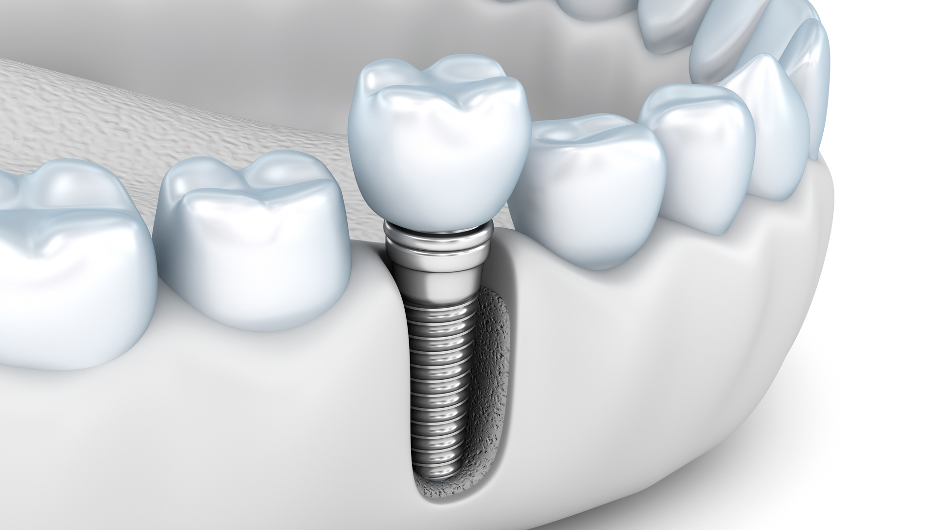 Purper hulp in de huishouding Er is behoefte aan Implantaten plaatsen – MAKZ Mondzorg Assen